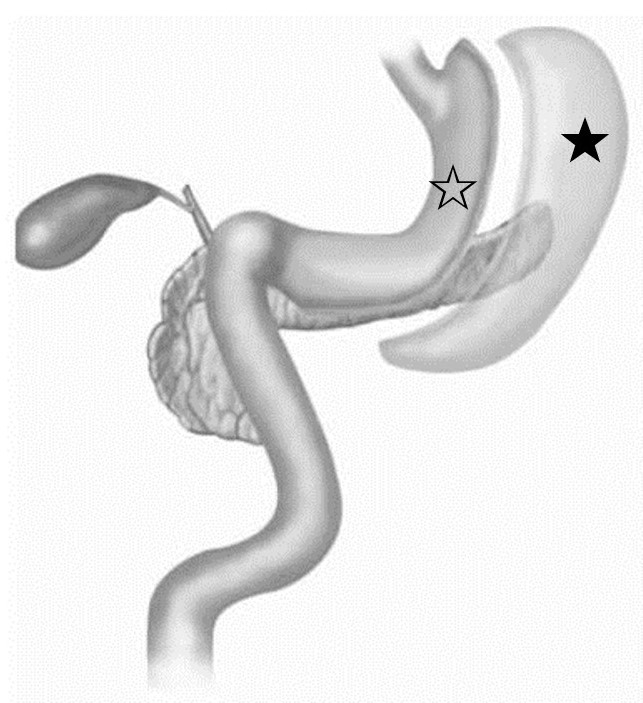 スリーブ状胃切除術のイメージ